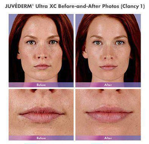 Juvederm Ultra Plus XC - Treatment for Lips and Nasolabial Folds