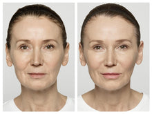 Load image into Gallery viewer, Restylane Lyft - Treatment for Cheeks