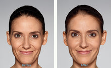 Load image into Gallery viewer, Restylane Refyne - Treatment for Nasolabial Folds