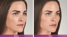 Load image into Gallery viewer, Juvederm Volbella - Treatment for Lips